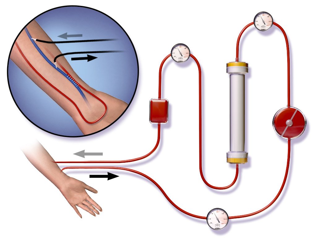Hemodialysis vs Peritoneal Dialysis — Which is Better?